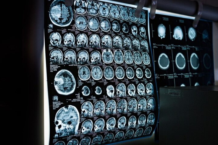 Rows of brain scan images on a light box