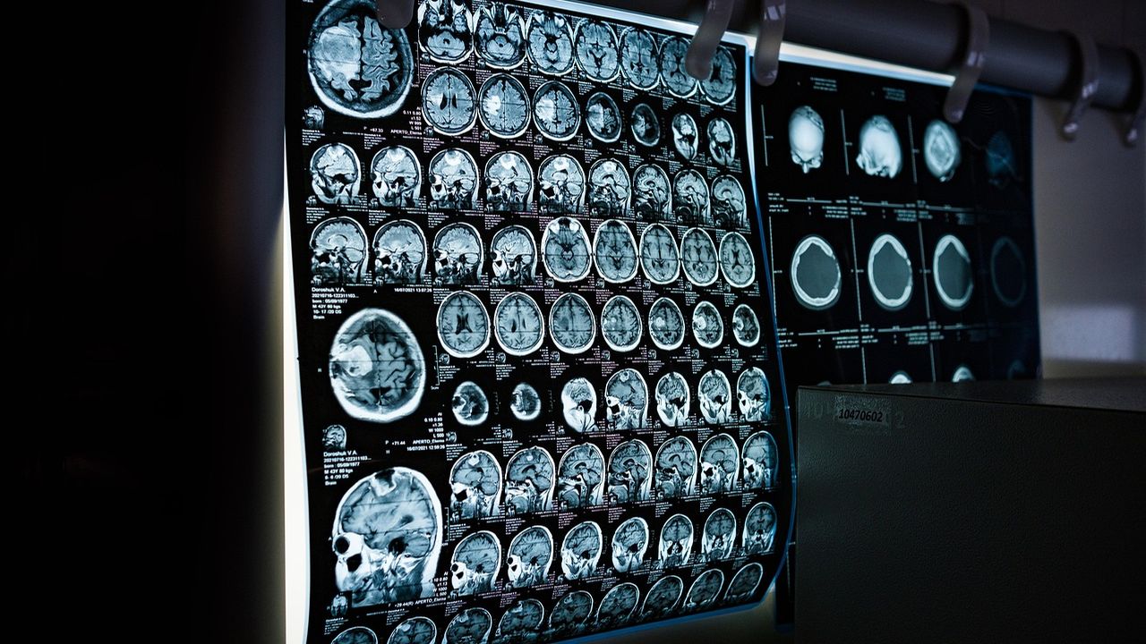 Rows of brain scan images on a light box